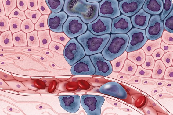 Illustration showing cancer cells (in purple) spreading to other parts of the body through the bloodstream.