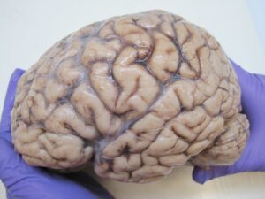 The human brain, obtained from autopsy.  Image: Wikipedia